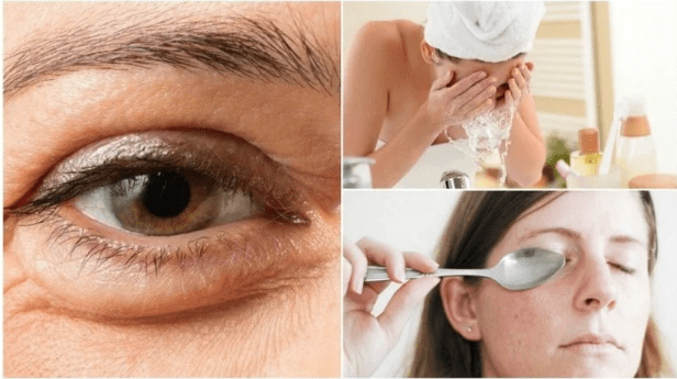 remedios naturales para reducir las bolsas debajo de los ojos