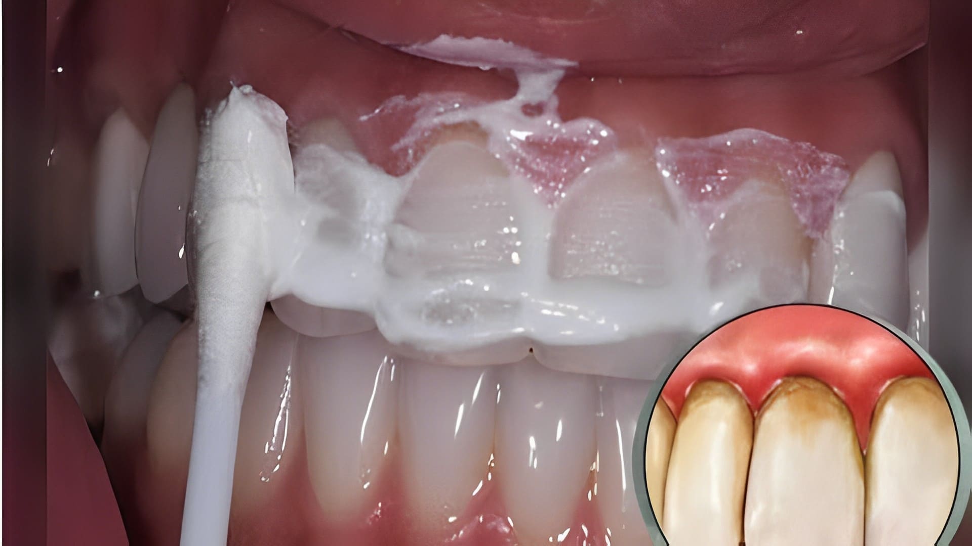 Combate el sarro dental, la gingivitis y blanquea tus dientes con estos remedios naturales en una semana
