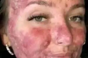 ¿Sufres de lupus cutáneo? Descubre remedios caseros que alivian los síntomas naturalmente