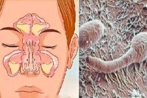 ¿Obstrucción nasal, rinitis o sinusitis? Sepa que el origen puede estar en el intestino. ¡Sepa cómo resolverlo! ¿Obstrucción nasal, rinitis o sinusitis? Sepa que el origen puede estar en el intestino. ¡Sepa cómo resolverlo!