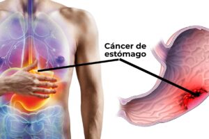 ¡Atención! Descubre los síntomas iniciales del cáncer de estómago que podrías estar pasando por alto