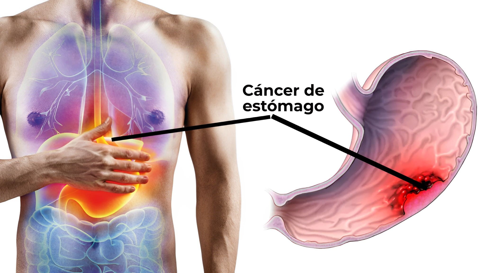 ¡Atención! Descubre los síntomas iniciales del cáncer de estómago que podrías estar pasando por alto.