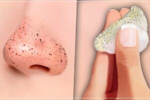 ¡Elimina los puntos negros de tu nariz con este increíble método casero!