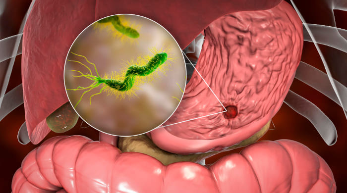 Helicobacter pylori: ¡La solución natural que estabas buscando para eliminarlo de tu vida!