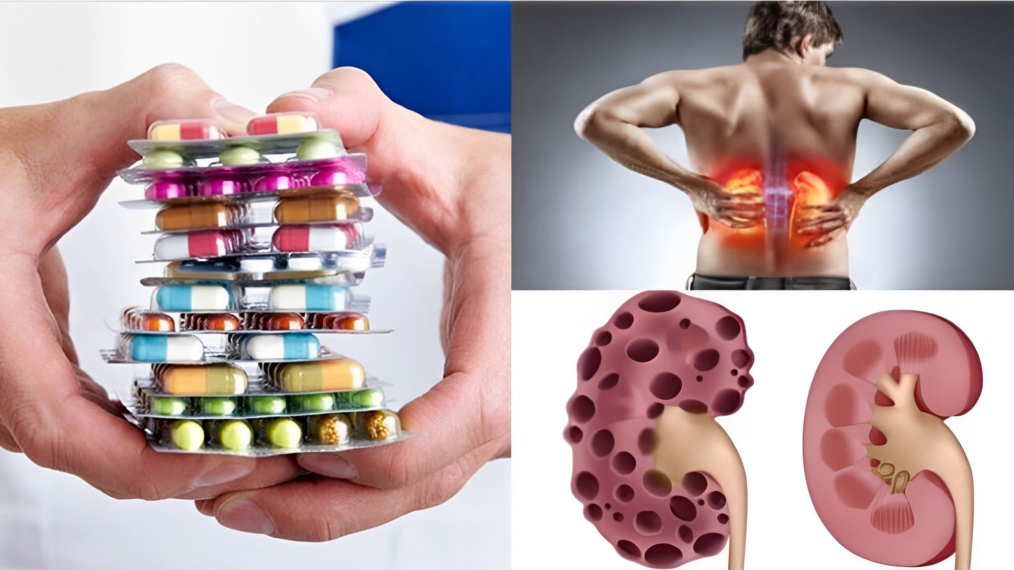 ¡Cuidado! Descubre las 8 pastillas que pueden destruir tus riñones si la consumes en exceso.