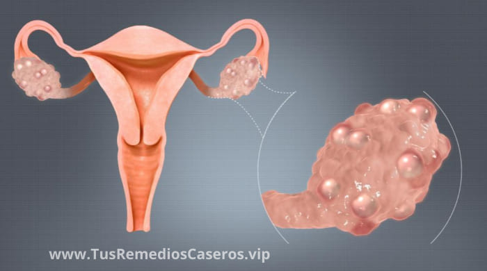 remedio casero ovarios poliquisticos