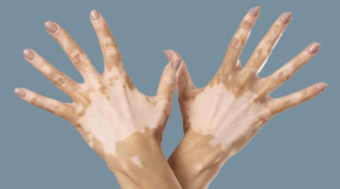 Remedios caseros para vitiligo